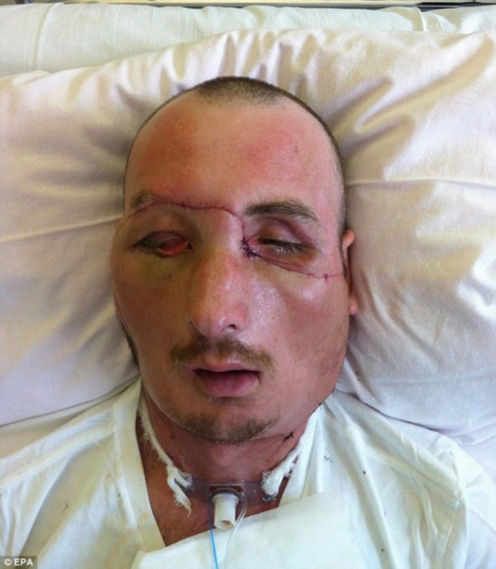 폴란드 남성 첫 사례의 긴급 “얼굴교체”수술 받아