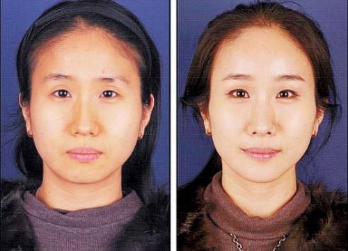 한국 미소성형수술 류행