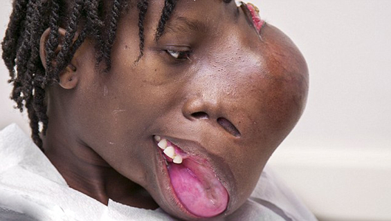 아이티 소녀 얼굴의 3.6근 종양 제거
