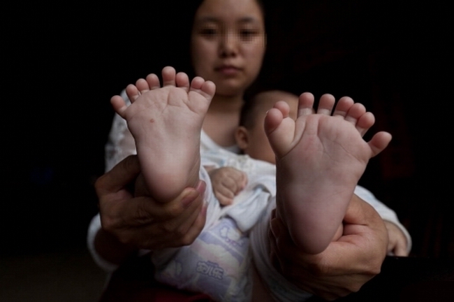 “문어손” 아이 출생…손가락, 발가락 모두 31개