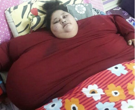 체중 500kg 녀성에 인도의사 '비만수술'